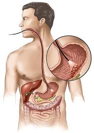 Stomach Cancer Picture