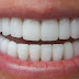 Τα βιο-δόντια αντικαταστούν τα εμφυτεύματα πορσελάνης