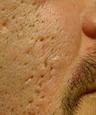 Steroid cream damage skin