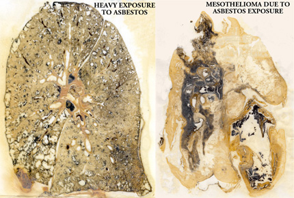 Mesothelioma Cancer