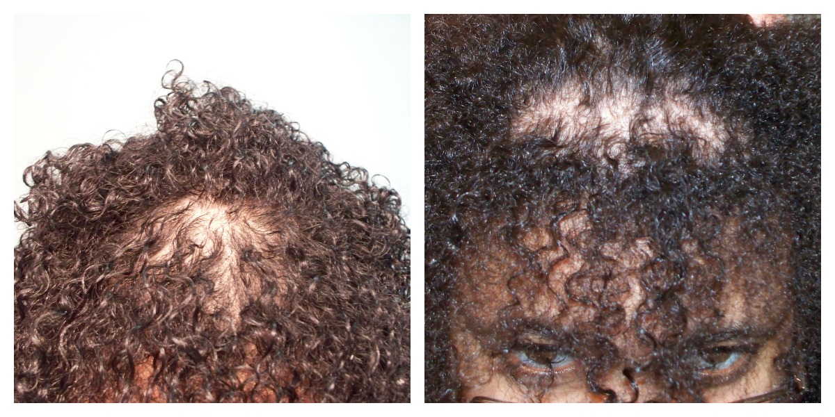 Regrow Hair On Crown Naturally Regrow Hair On Crown Naturally