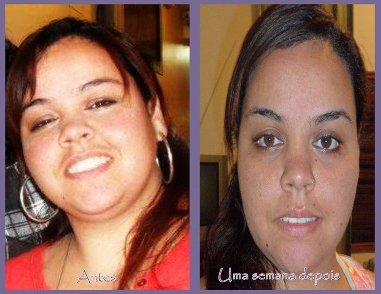 Sleeve Diaries Meu Diário de Gastropastia Cirurgia, Dieta Líquida e