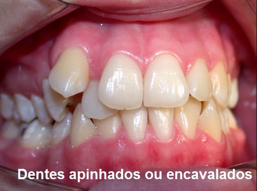 Featured image of post Imagens De Dente Encavalado : É natural que as pessoas que possuem algum dente encavalado se incomodem com este fato.