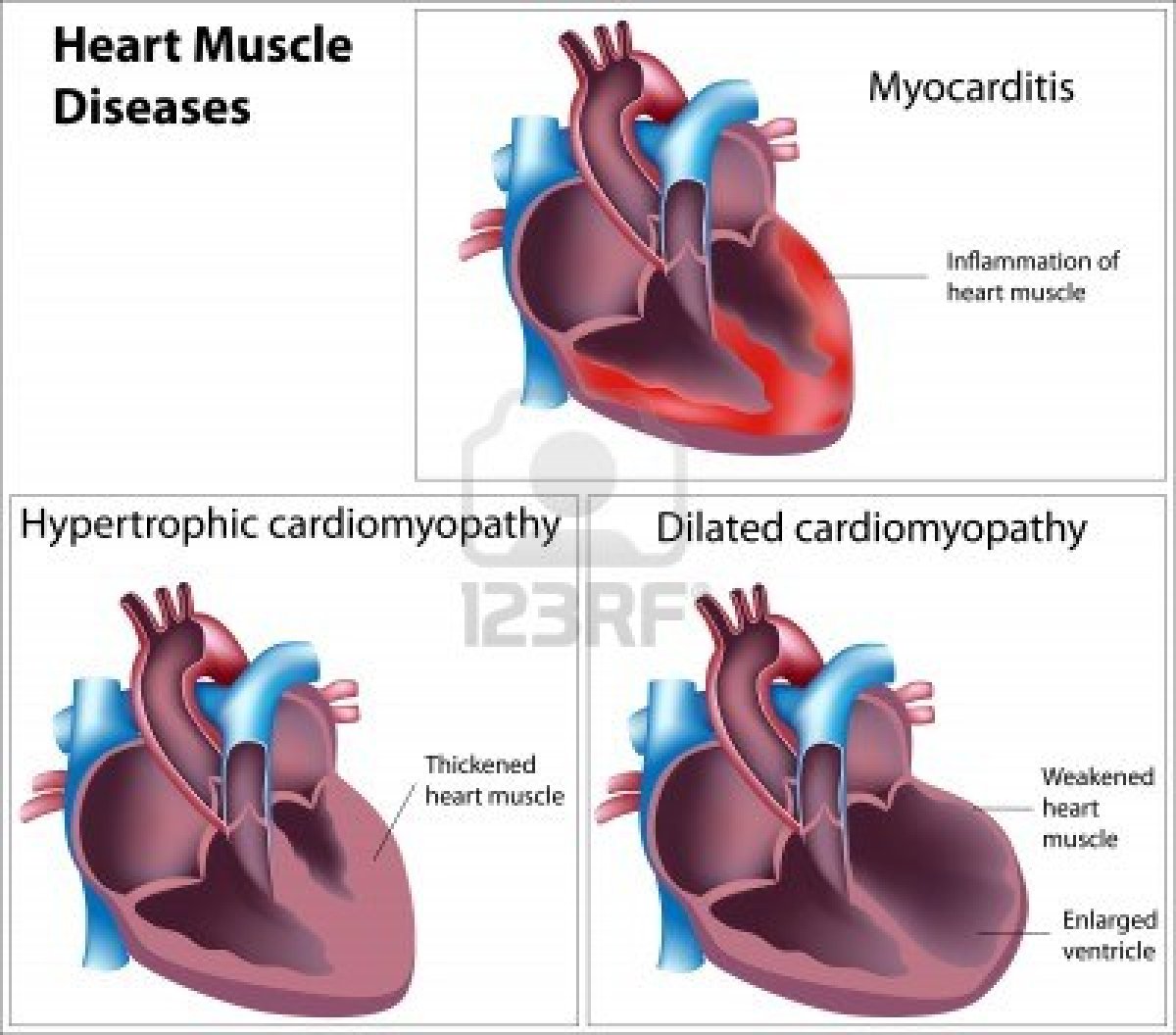 Medical Transcription: Heart Muscle