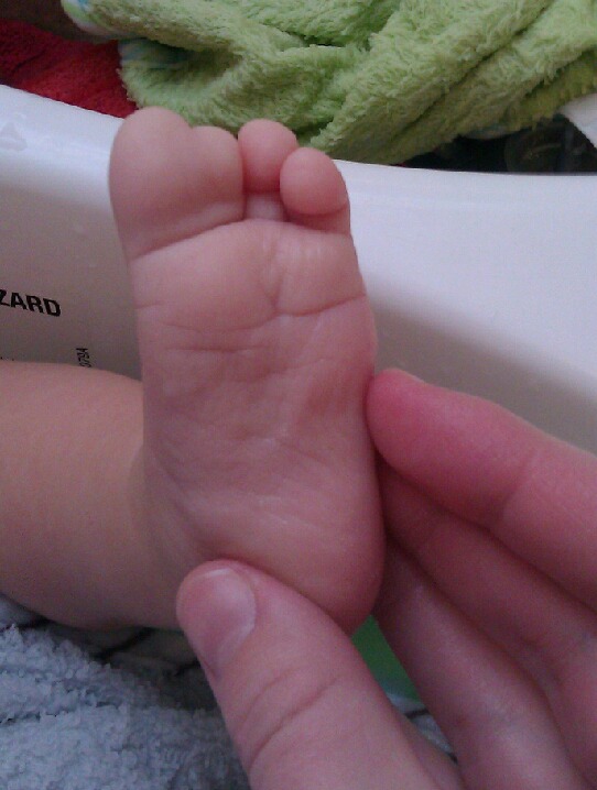 baby webbed toes
