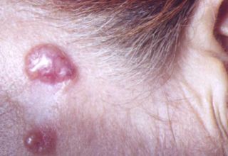 Carcinome basocellulaire Le carcinome basocellulaire est un cancer de la peau dont l'évolution est très favorable sous traitement. Les autres cancers de la peau sont le carcinome spinocellulaire et le → mélanome malin. Épidémiologie Il s'agit du plus fréquent des cancers (près de la moitié des cas) aux États-Unis et son incidence semble s'accroître. Il touche particulièrement les personnes à la peau claire (blonds ou roux) et est corrélé à l'exposition au soleil et aux rayonnements ultraviolets.