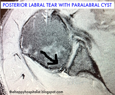 tear labral shoulder posterior mri pain surgery right experience without