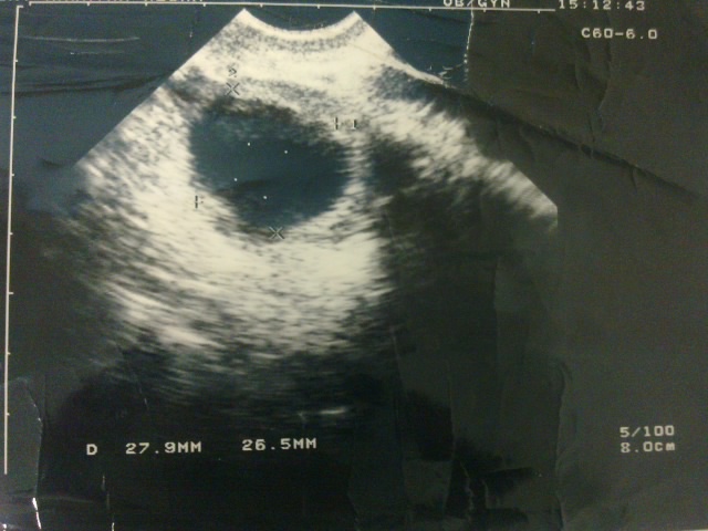 Clomid Dosage Increase