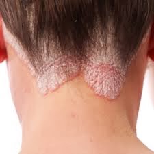 Como reforzar la psoriasis