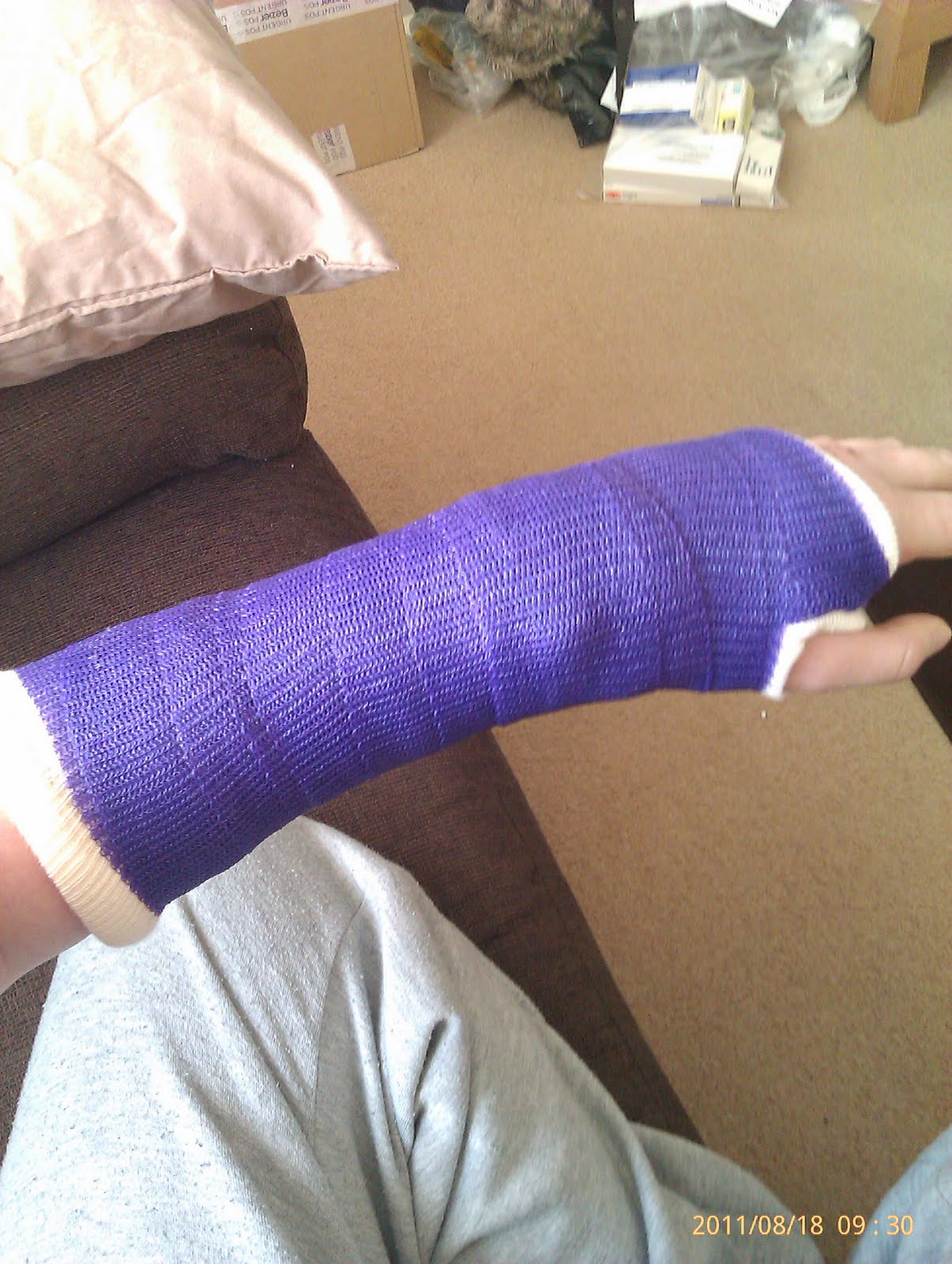 Katies bits and blogs Wrist fusion surgery S