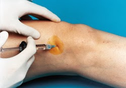 Steroid injection knee arthritis