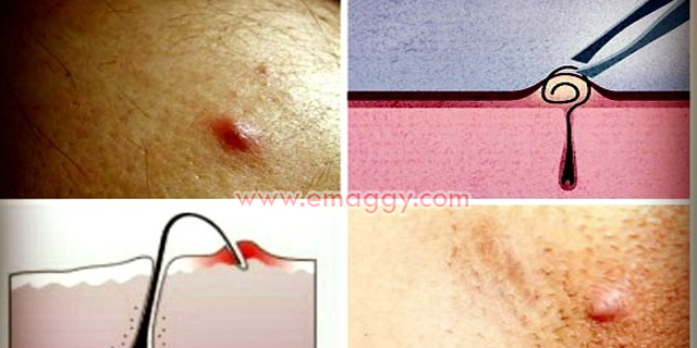 Simple Ingrown Hair In Chest | simple ingrown hair in chest simple ingrown hair in chest Simple Ingrown Hair In Chest | simple ingrown hair in chest simple ingrown hair in chest