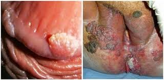 Jenis Obat Kutil Jenis Obat Kutil