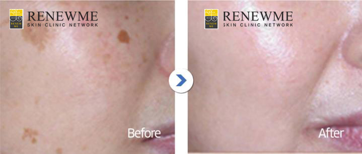 renewme skin clinic whiter brighter face with lasers at renewme skin clinic whiter brighter face with lasers at