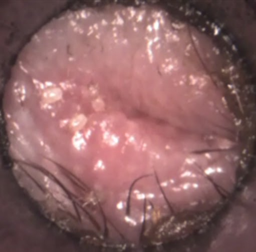 Otodectes Cynotis