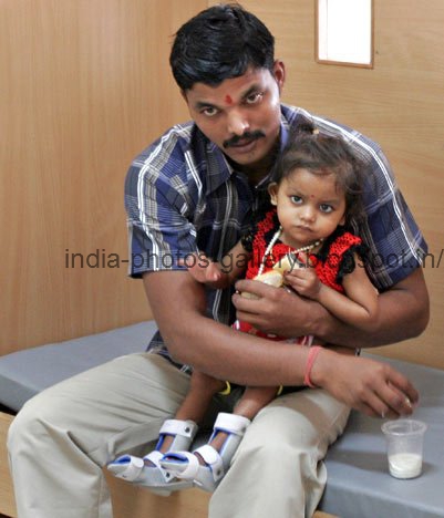 what are the defects of indian Birth defects (also called congenital anomalies) are problems present at birth there are many different types of birth defects, and they can range from mild to severe. what are the defects of indian Birth defects (also called congenital anomalies) are problems present at birth there are many different types of birth defects, and they can range from mild to severe.