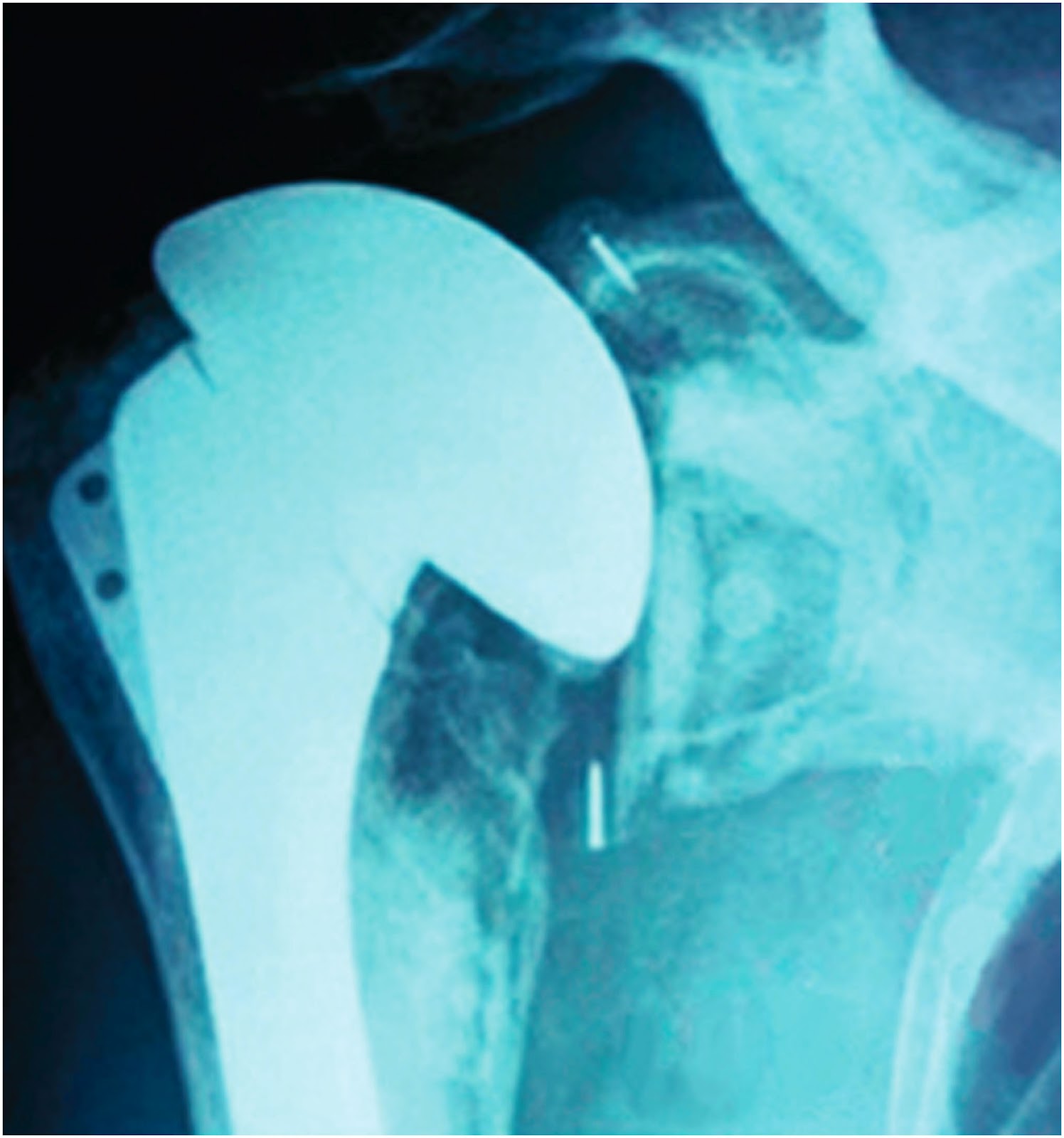 Shoulder Arthritis / Rotator Cuff Tears causes of