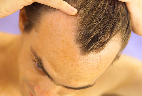 Male Pattern Baldness - News, Information on Male Pattern Baldness