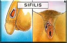 Ciri Ciri Penyakit Sipilis Ciri Ciri Penyakit Sipilis Pria Dan Wanita
