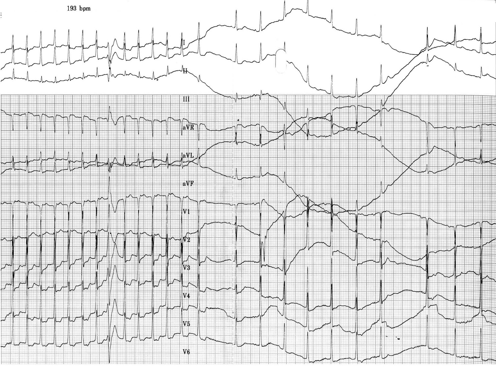 ECG Rhythms The effect of a spontaneous PVC in a supraventricular