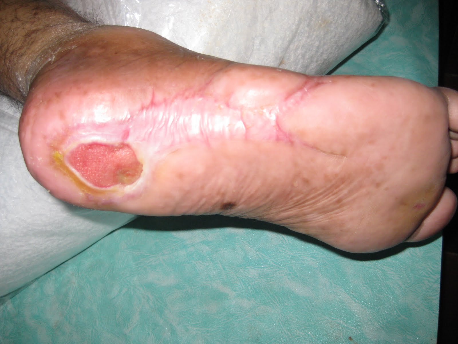 MAGGOT DEBRIDEM...