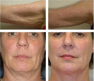 Anti-Aging Skin Care What is the Best Treatment For Crepey Skin?