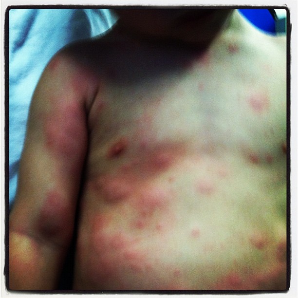 Amoxicillin Side Effects - Buzzle Web Portal: Intelligent Life on.