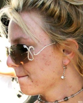 http://4.bp.blogspot.com/-3DxXNaXBXLk/UAm1AY0BAgI/AAAAAAAADQk/EIlDglObluQ/s400/britney-spears-acne-3.jpg