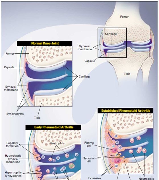 Expatriados Online Rheumatoid Arthritis Overview, Molecular