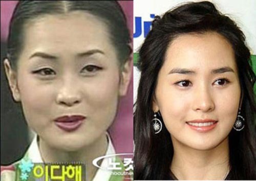 Kwang Hee Plastic Surgery Before and After Plastic.
