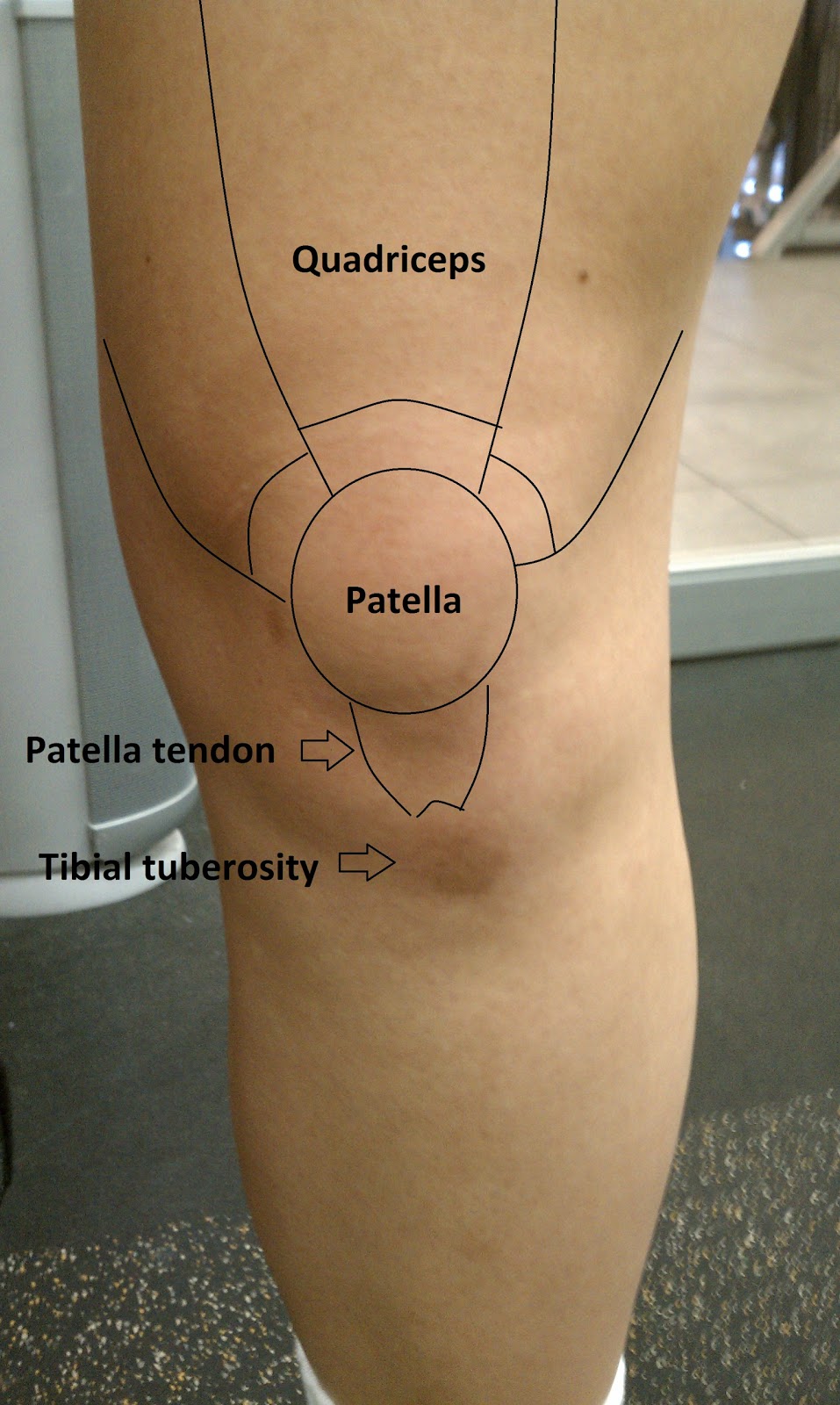Dr. David Kwon's Blog: Ouch My Knee Hurts!!! [Part 2]