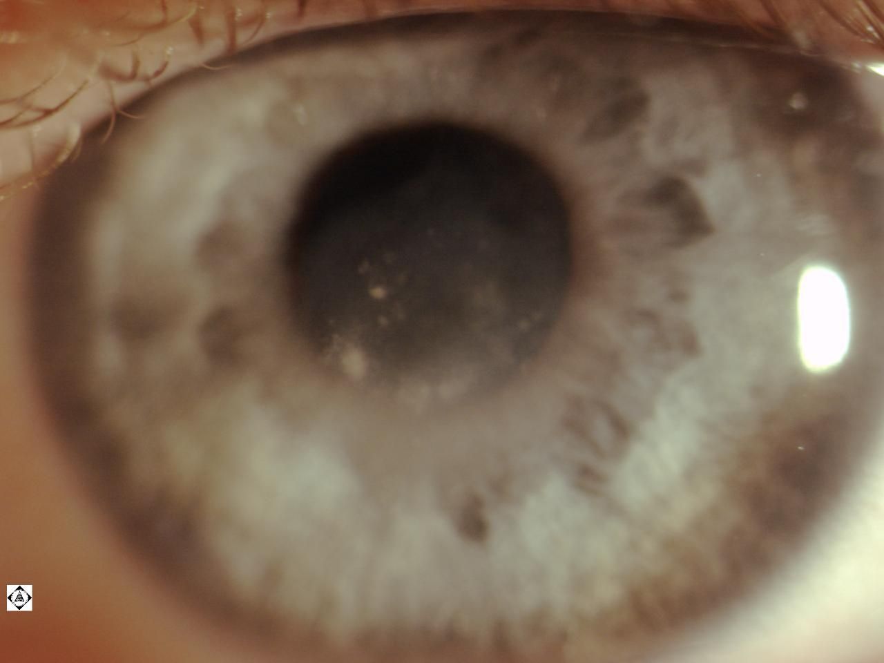 Sonoran Desert Eye Center CORNEA SCAR