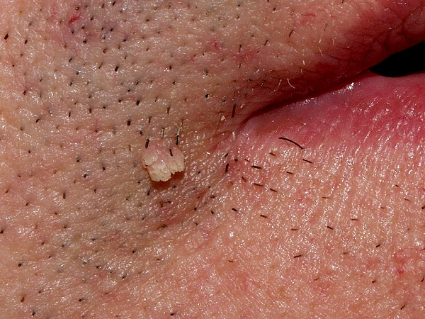 donde salen las verrugas genitales verrugas quem te quer geri e derme beauty donde salen las verrugas genitales verrugas quem te quer geri e derme beauty