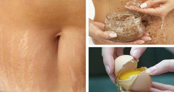 Recommendations To Avoid Or Reduce Stretch Marks Reduce Stretch Marks