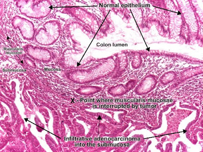 Histology and explanation of Moderately differentiated adenocarcinoma (colon)