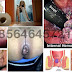 Obat Wasir Kronis Tanpa Operasi thumbnail