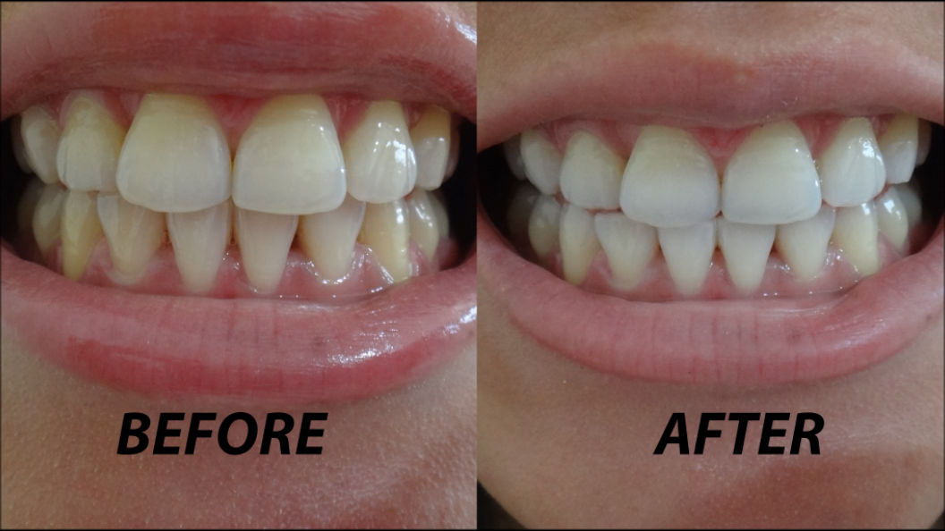 MakeupDownUnder Crest 3D Whitestrips Vivid before & after, demo + review