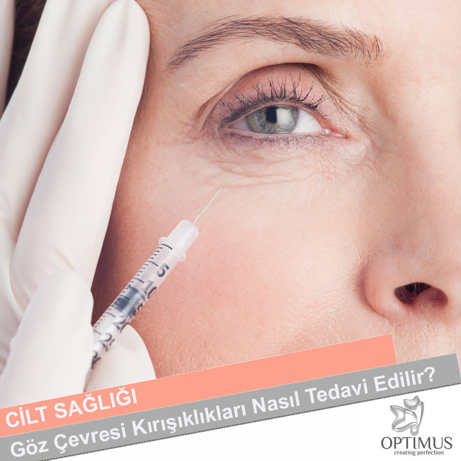Göz Çevresi Kırışıklıkları Nasıl Yok Edilir Göz Çevresi Kırışıklıkları Nasıl Yok Edilir