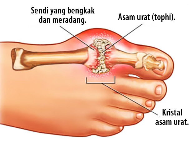 Kesamaan dan Perbedaan Osteoarthritis dan Osteoporosis