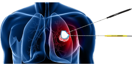 cryosurgery / Cryoablation cancer therapy to achieve remission lung cancer patients / tumor or other metastatic cancers