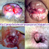 Jual Salep Wasir Ambeien Ampuh thumbnail