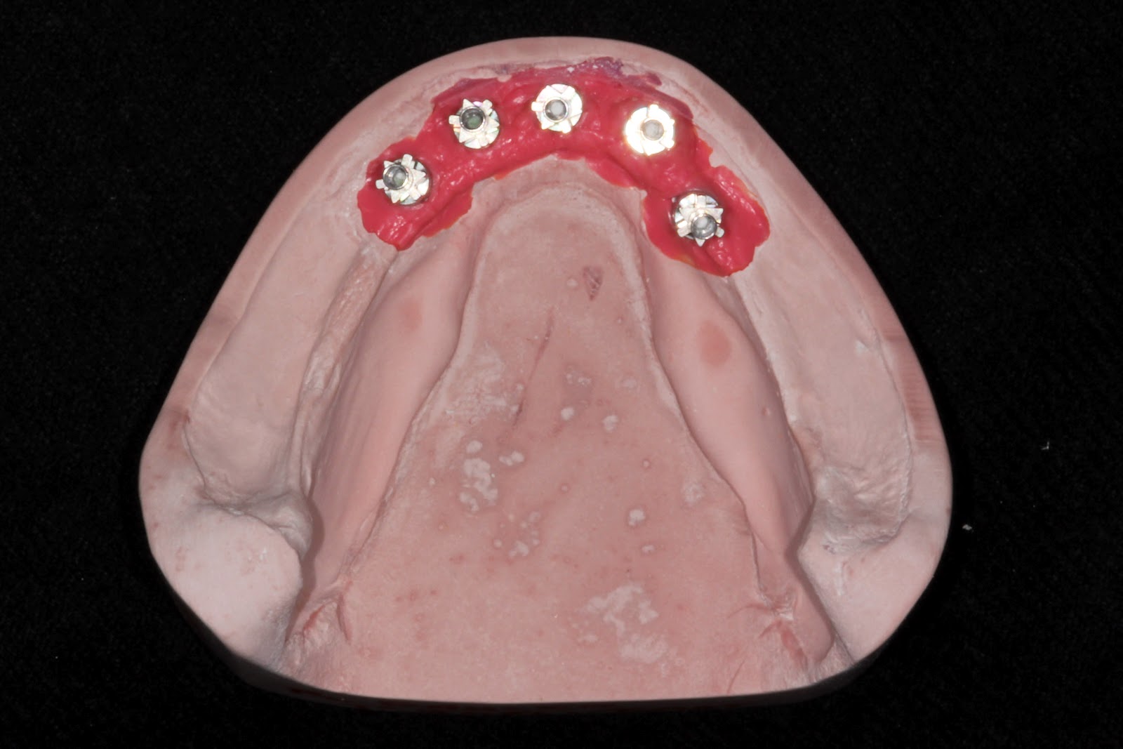 Boise Idaho Prosthodontics Preliminary Mandibular Hybrid Open Tray