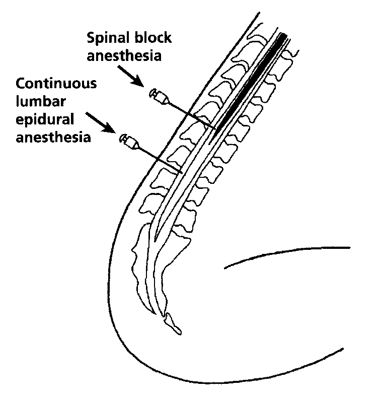 spinal needle into the spinal fluid