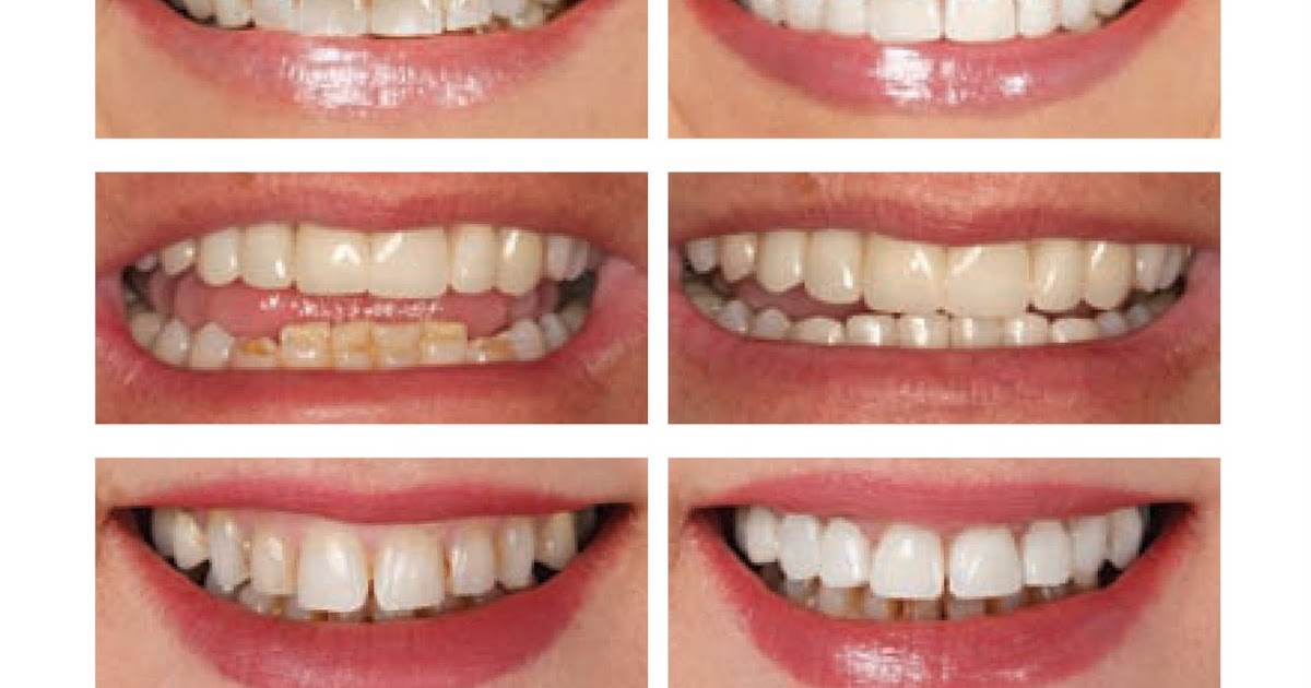 Dental Pearls Porcelain Veneers in One HourNew permanent Cerinate Veneers