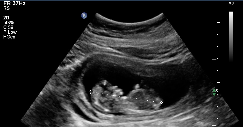 weeks ultrasound days then comes
