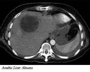 My Gastro Room: CT:Non-Cancerous cystic Liver Lesions