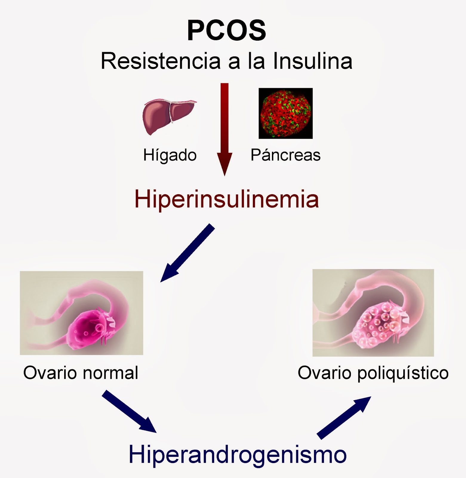 Hormonas : Síndrome del ovario poliquístico (PCOS, SOP) I Hormonas : Síndrome del ovario poliquístico (PCOS, SOP) I