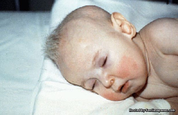 Sindrom Menkes, Penyakit Misteri Yang Menyerang Bayi Sindrom Menkes