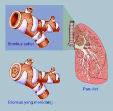 obat penyakit bronkitis kronis obat tradisional obat penyakit bronkitis kronis obat tradisional
