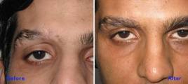 Beauty Health And Other Stuff Augenbrauen Implantieren